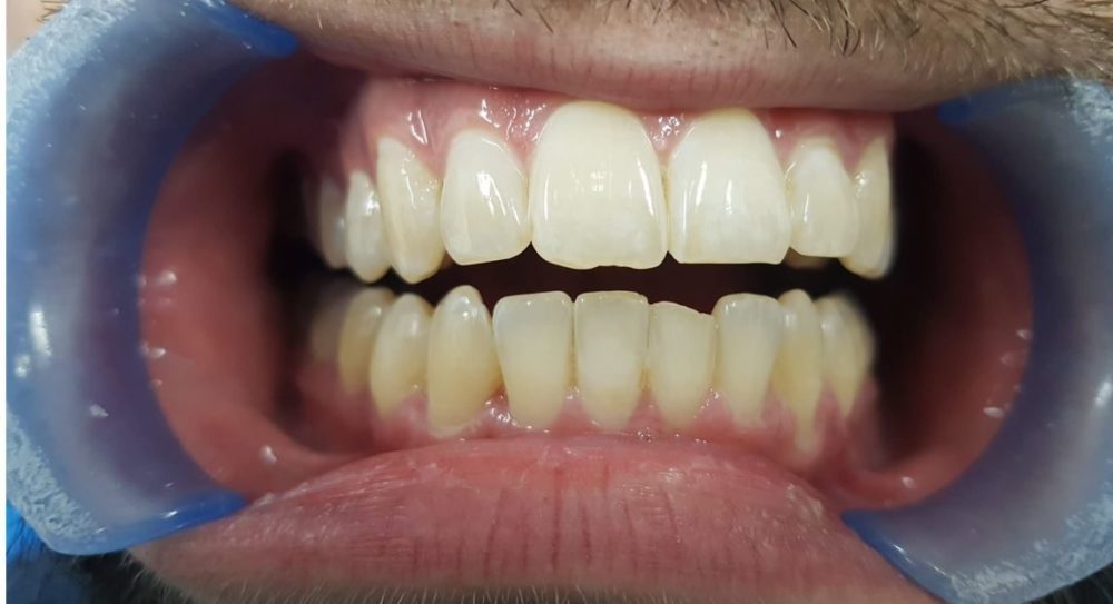 Invisalign Bristol after case 1 straight teeth