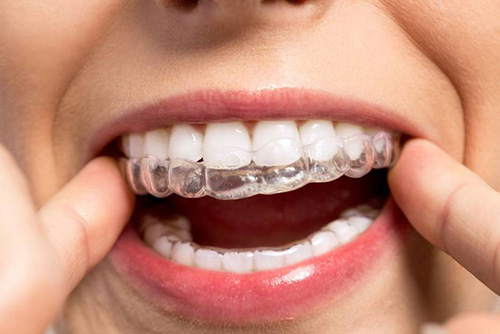 Invisalign Bristol clear aligner patient smiling
